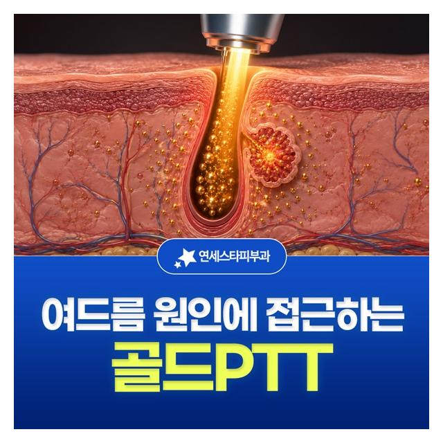 골드PTT, 여드름 원인에 접근하는 치료 재발은 낫고 효과는 높이는